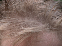 Trichotillomania