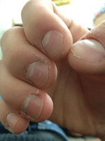 Onychophagia nail biting